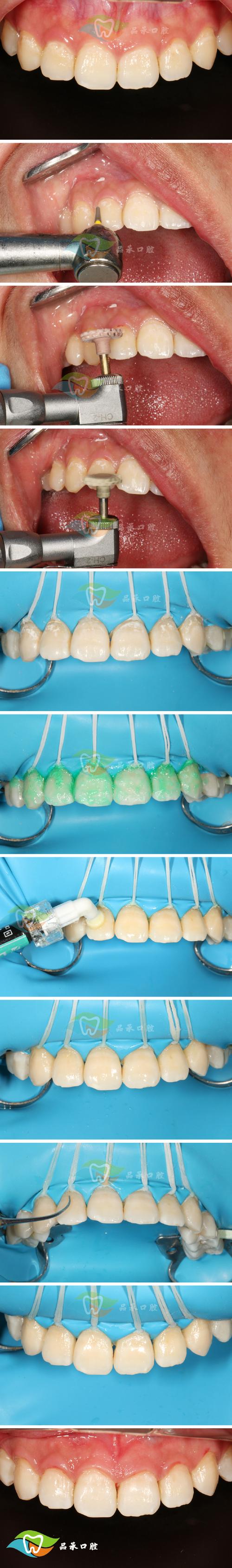 树脂临时冠正畸-图1