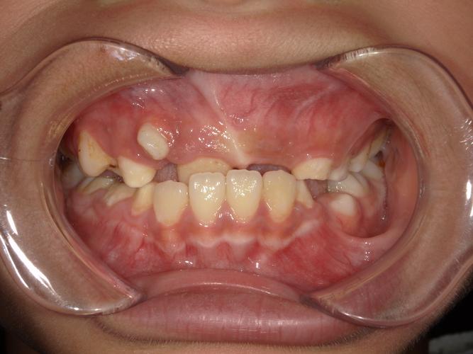 异位牙3 正畸-图1 异位牙3 正畸-图1