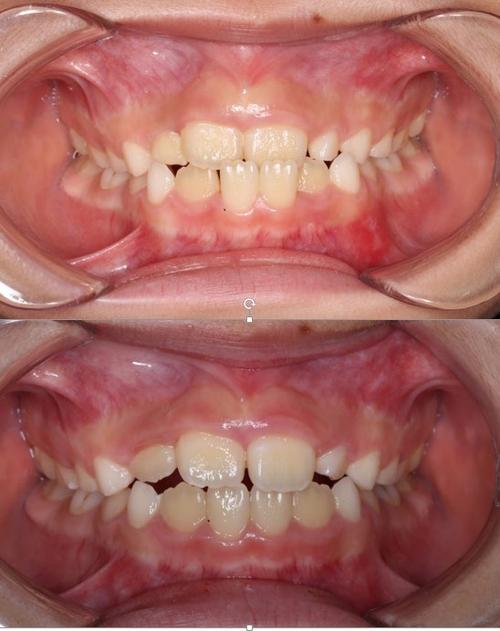 正畸中整体移动-图2 正畸中整体移动-图2