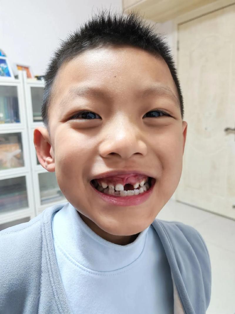 正畸中门牙脱落-图2 正畸中门牙脱落-图2