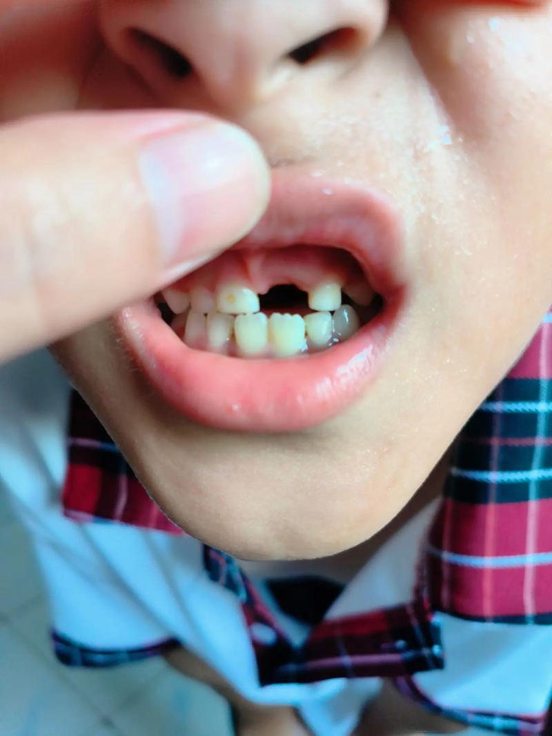 正畸中门牙脱落-图3 正畸中门牙脱落-图3