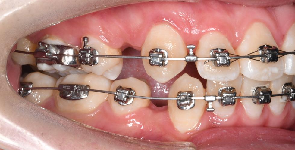 正畸修复的课题-图1