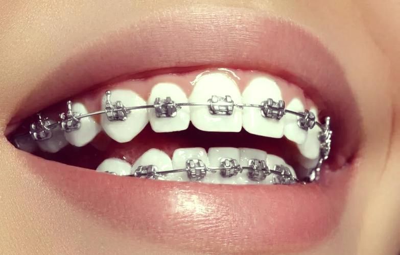 正畸方形勾托槽-图2