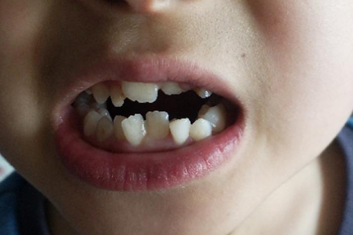 正畸期间门牙歪了，是矫正异常还是正常现象？-图1