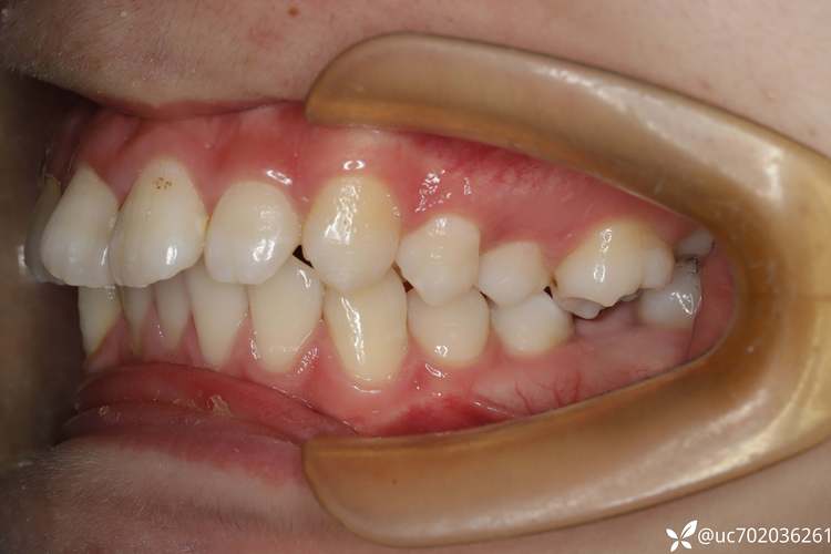 正畸后下牙错位,是矫正失败还是需要二次处理?-图1 正畸后下牙错位,是矫正失败还是需要二次处理?-图1