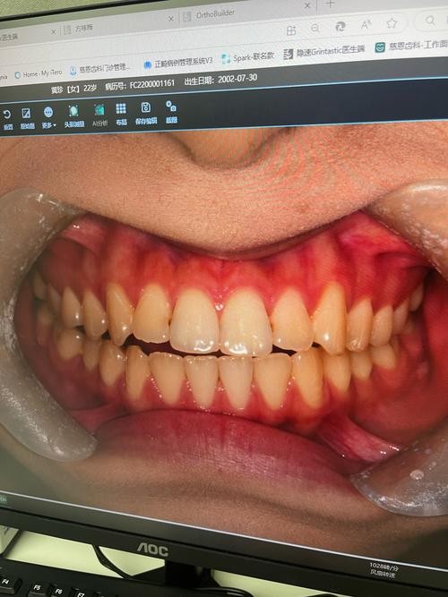 正畸后下牙错位,是矫正失败还是需要二次处理?-图2 正畸后下牙错位,是矫正失败还是需要二次处理?-图2