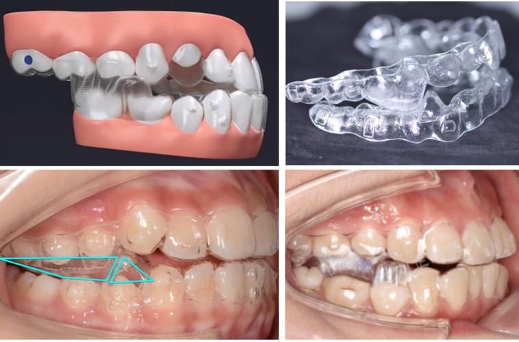 牙齿矫正导板有什么用-图1