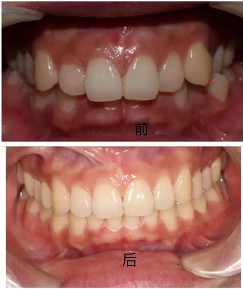 25岁矫正牙齿，效果好不好？时机合适吗？-图2