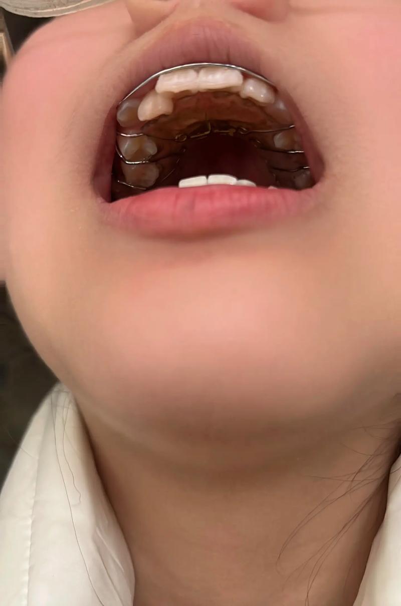 扩弓矫正后牙齿图片能展示哪些矫正效果变化？能看出改善吗？-图2