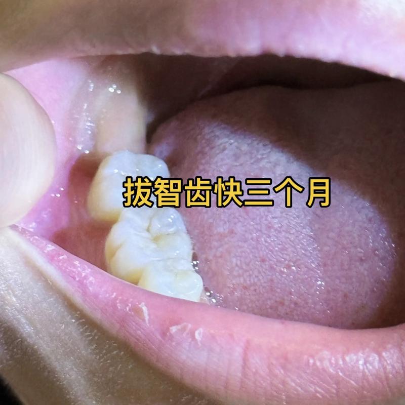 拔完智齿能矫正牙齿吗-图1 拔完智齿能矫正牙齿吗-图1