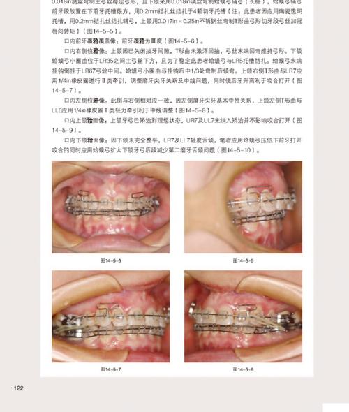 矫正牙齿的弓丝的分类-图3