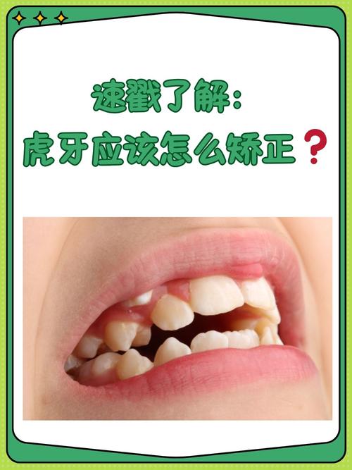 有虎牙怎么做牙齿矫正-图2