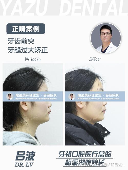 牙齿缝隙大需要矫正吗-图2