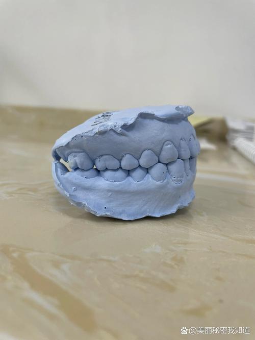 牙齿矫正取模后的牙模，患者能带走吗？-图1