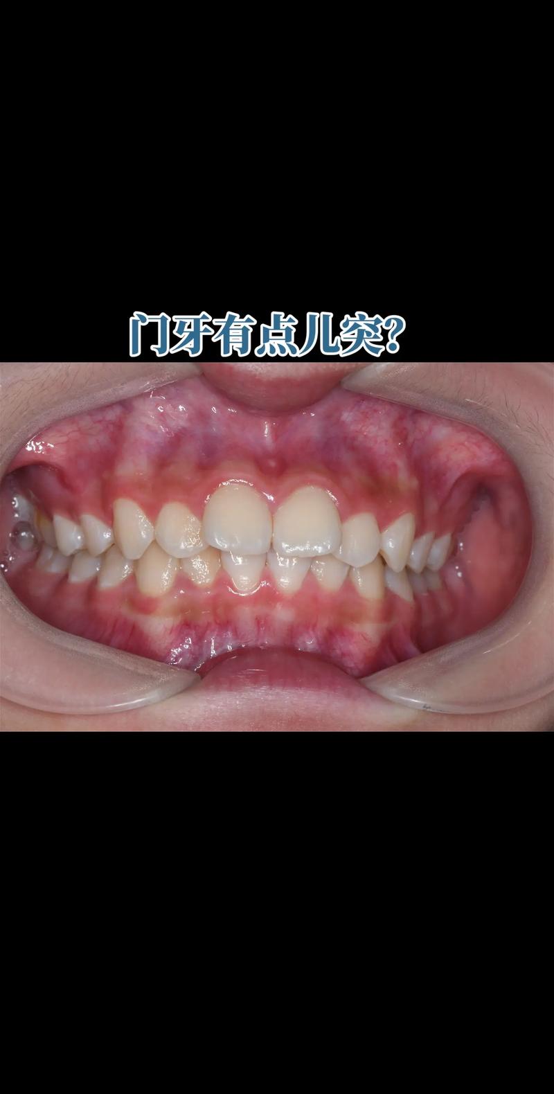 矫正牙齿一个门牙外凸-图2