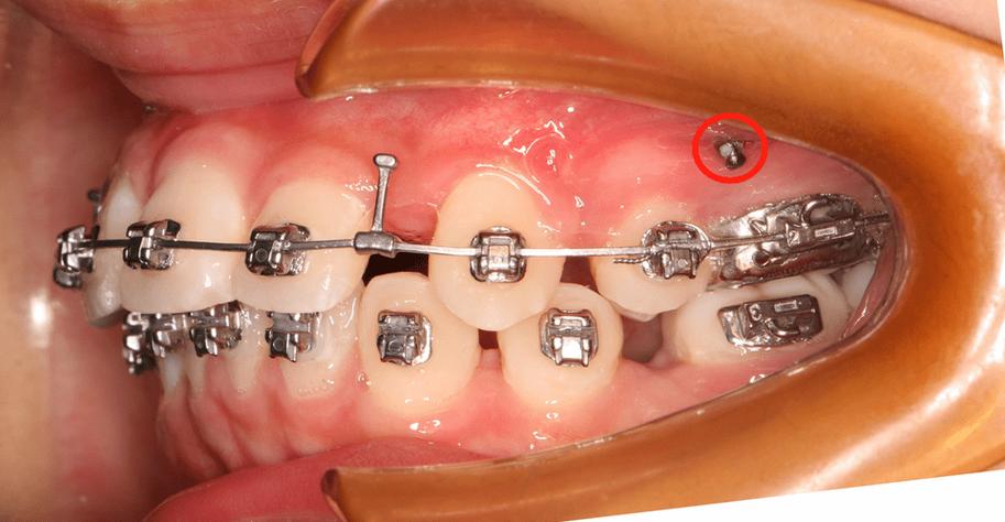 牙齿矫正都要打骨钉吗？-图1