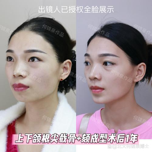 牙齿矫正后颧骨会变吗-图2