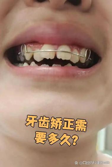 年龄大了，牙齿还能矫正吗？-图3