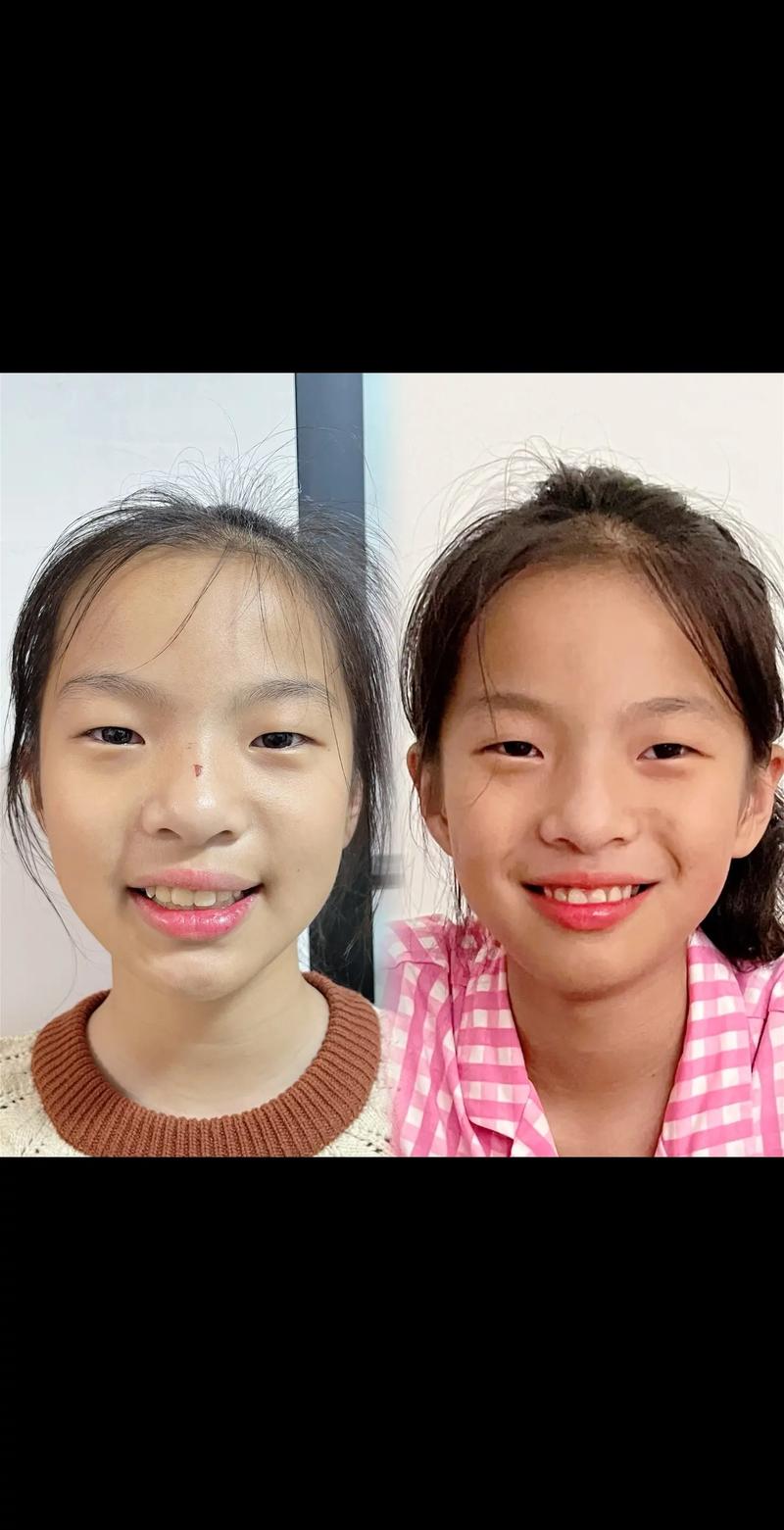 牙齿稀疏矫正前后效果-图1