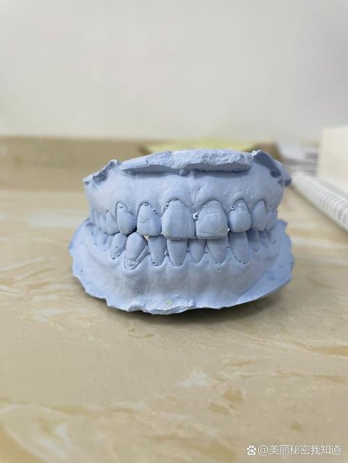矫正牙齿为什么要做牙模？关键作用究竟是什么？-图1