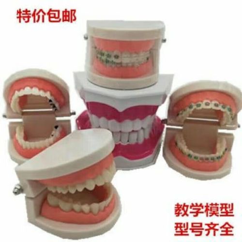 矫正牙齿为什么要做牙模？关键作用究竟是什么？-图3