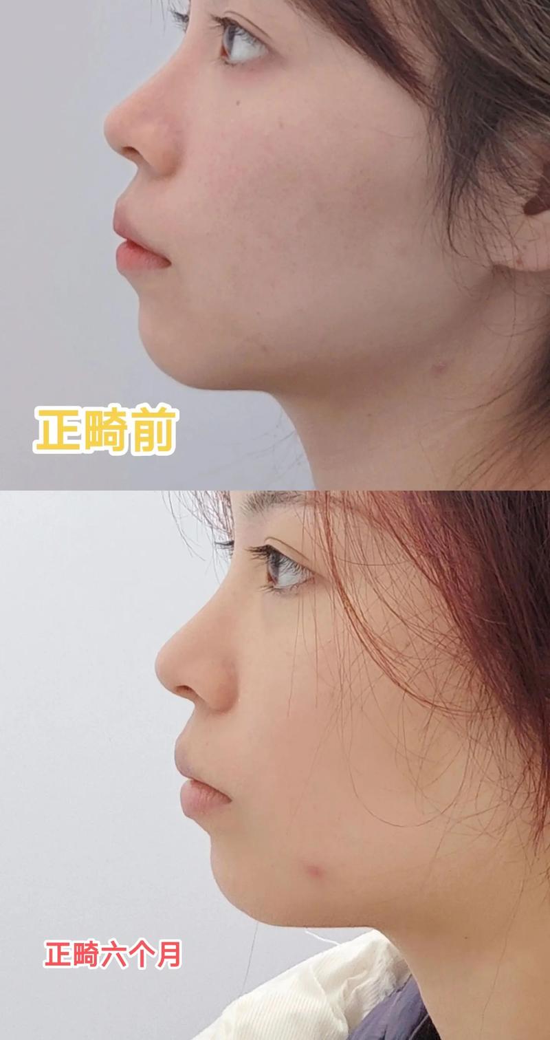 牙齿矫正几个月有变化-图1