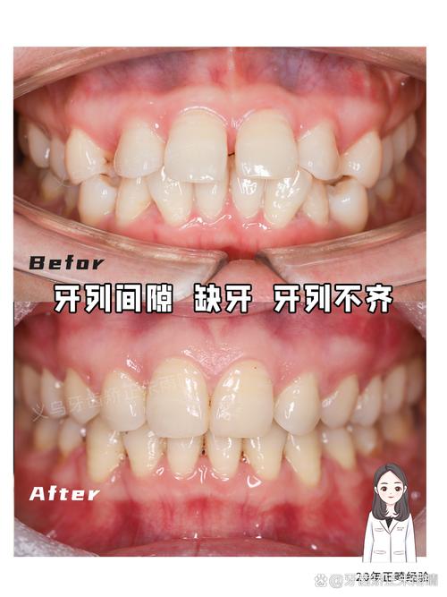 20岁矫正牙齿，真的会有后遗症吗？-图2