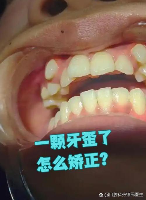 矫正后大牙歪了，是矫正失败吗？-图1
