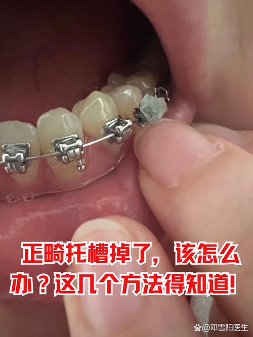 为什么托槽能矫正牙齿-图1