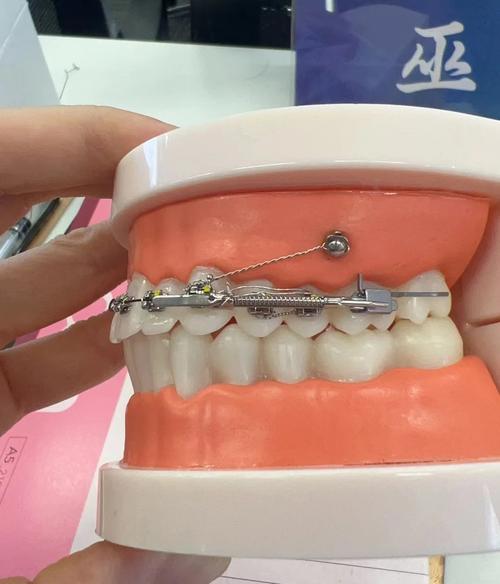 牙齿可以从里面矫正吗-图2