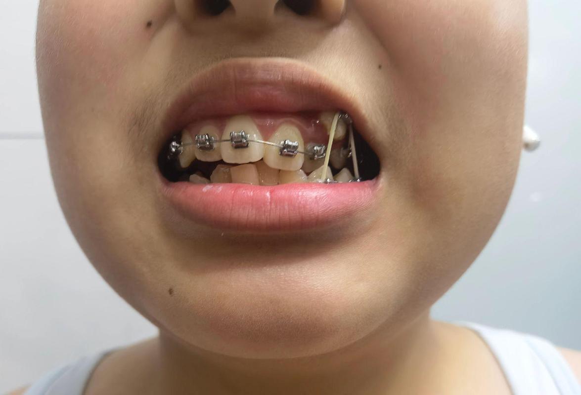 小孩牙齿矫正疼不疼？-图3