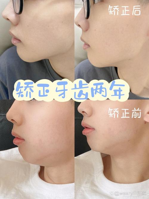 矫正牙齿会影响鼻子的形状或外观吗？-图2