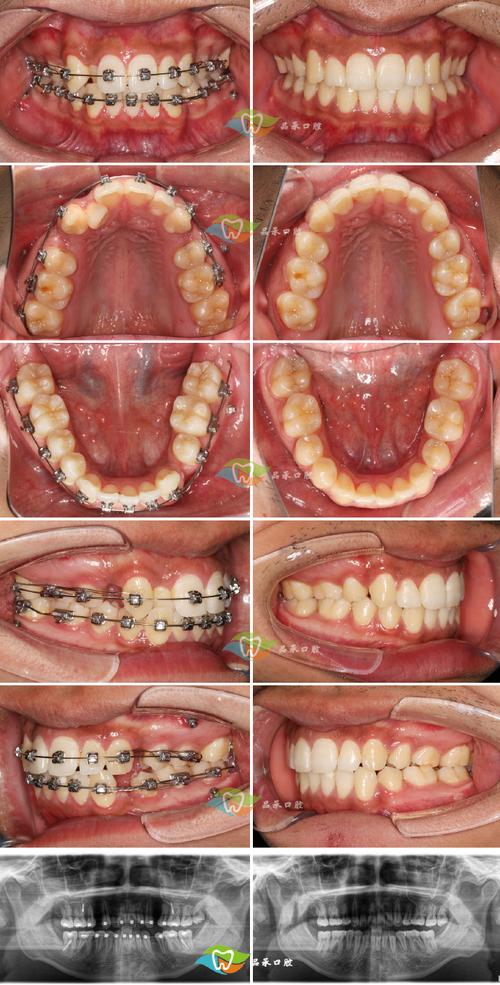 拔牙矫正牙齿后反弹风险有多大？如何保持矫正效果不反弹？-图3