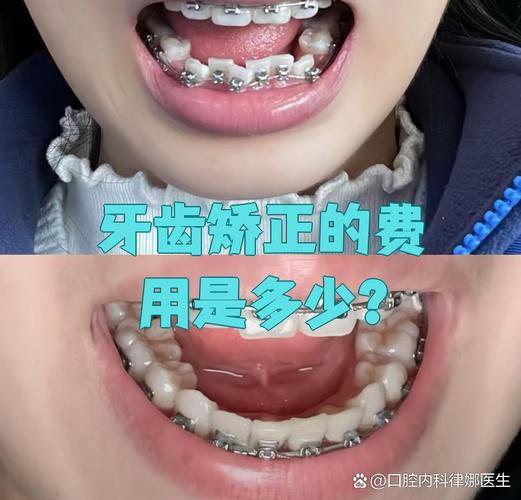 牙齿咬合不齐，矫正该做吗？-图2