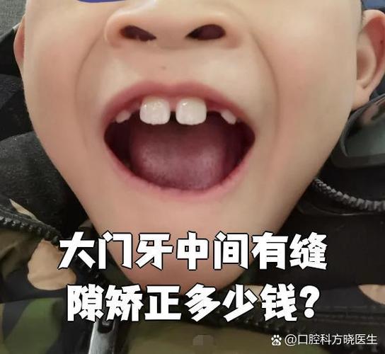 矫正牙齿门牙为何有缝隙？正常吗？需处理吗？-图1