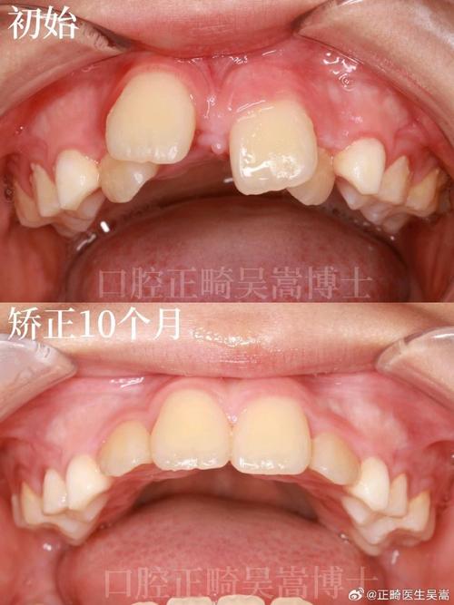 矫正牙齿门牙为何有缝隙？正常吗？需处理吗？-图2