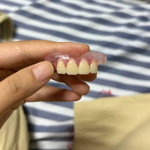 矫正牙齿门牙为何有缝隙？正常吗？需处理吗？-图3