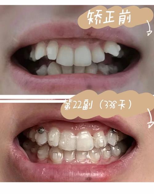 广州隐形牙套矫正效果如何？价格贵不贵？-图2
