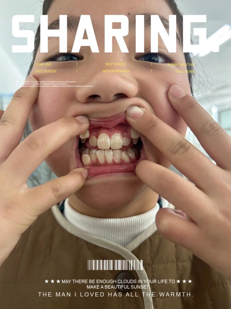 拔牙后矫正牙齿反弹了-图2