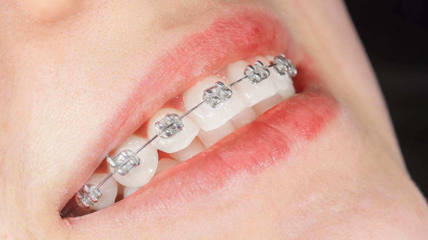 单晶托槽牙齿矫正图片-图2