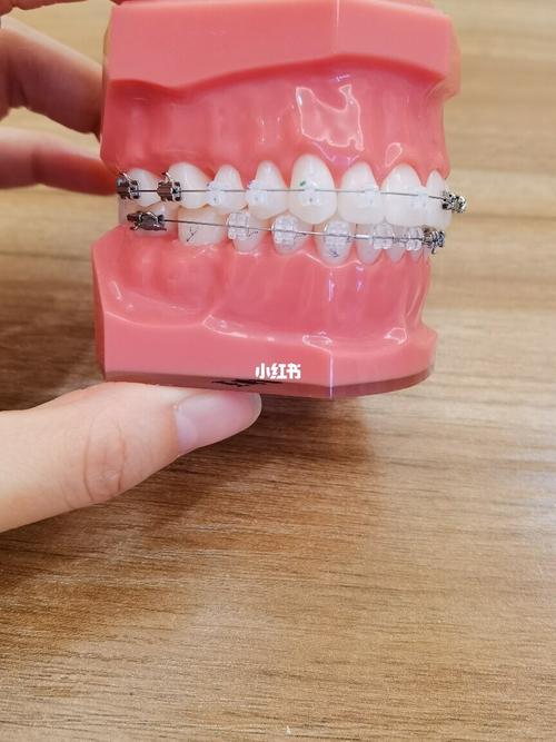 单晶托槽牙齿矫正图片-图3