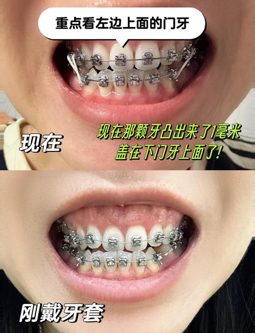 牙齿矫正后多久能看到明显变化？-图1