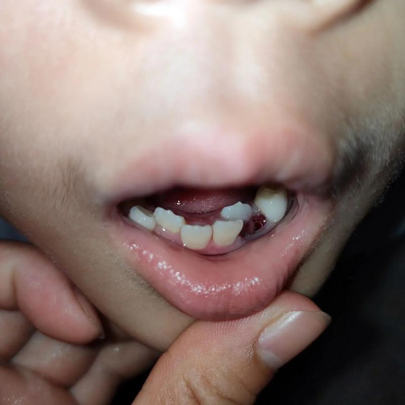 矫正牙齿前门牙被拔，是必须的矫正步骤吗？-图2