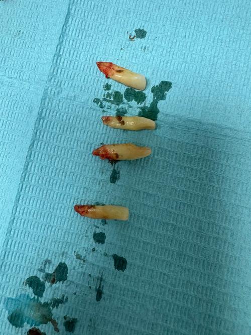 矫正牙齿前门牙被拔，是必须的矫正步骤吗？-图3