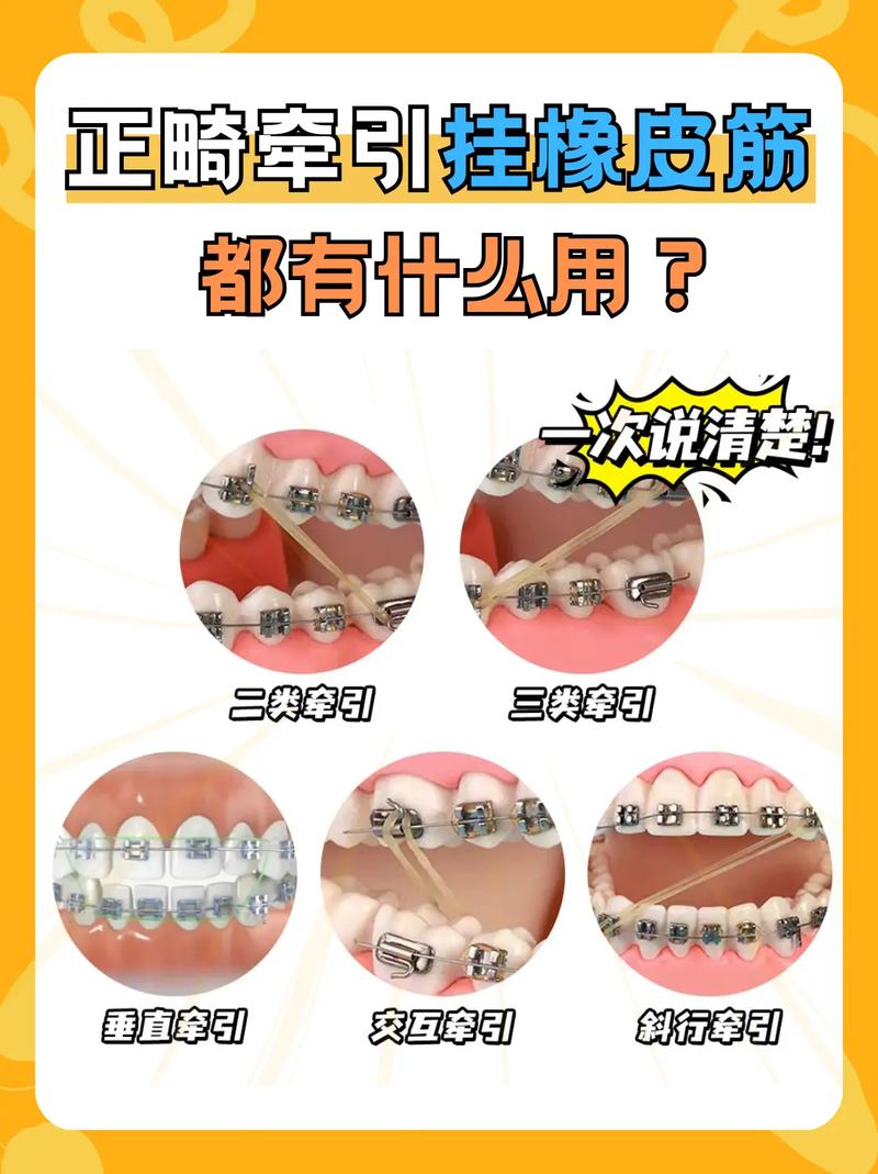 矫正牙齿的皮筋怎么戴才有效？步骤详解-图1