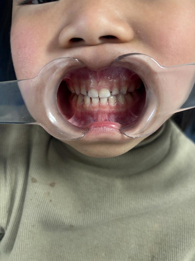 婴儿地包天需要矫正吗？矫正的最佳时机是什么时候？-图2