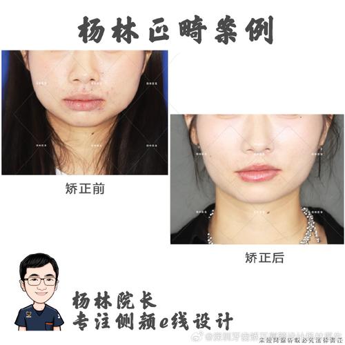 牙齿矫正真的能让鼻子变小吗？-图2