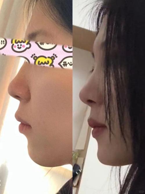 牙齿矫正真的能让鼻子变小吗？-图1