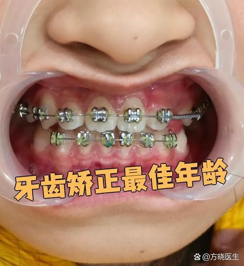 年龄大了矫正牙齿还来得及吗？-图3