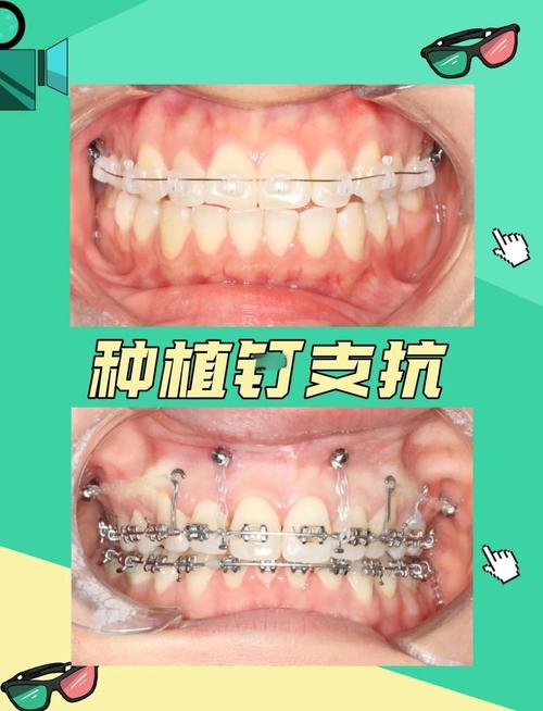 矫正牙齿真的需要打钉子吗？专家详解矫正钉子的必要性-图2